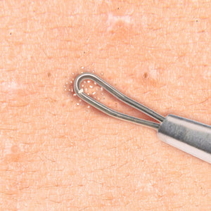 Double Loop Blackhead Remover Pimple Extractor