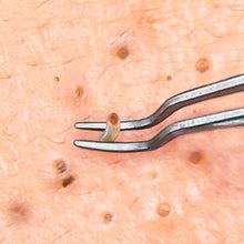 Load image into Gallery viewer, Bend Curved Blackhead Remover Pimple Blemish Extractor
